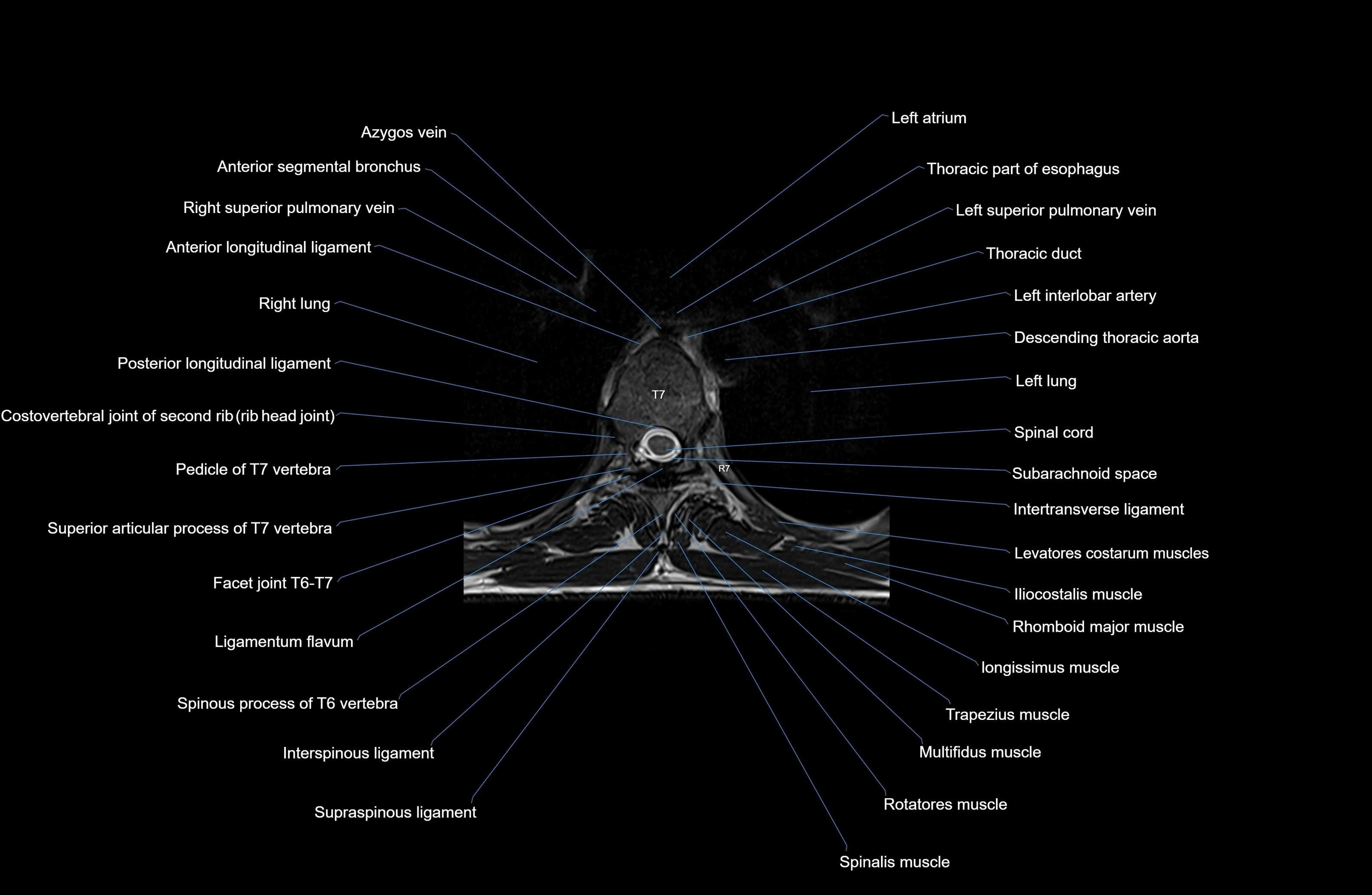 MRI thoracic spine axial  cross sectional anatomy 3T radiology  image-img-00001-00044.webp